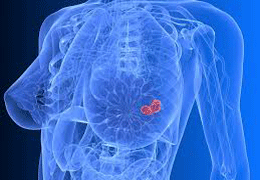 рак молочной железы